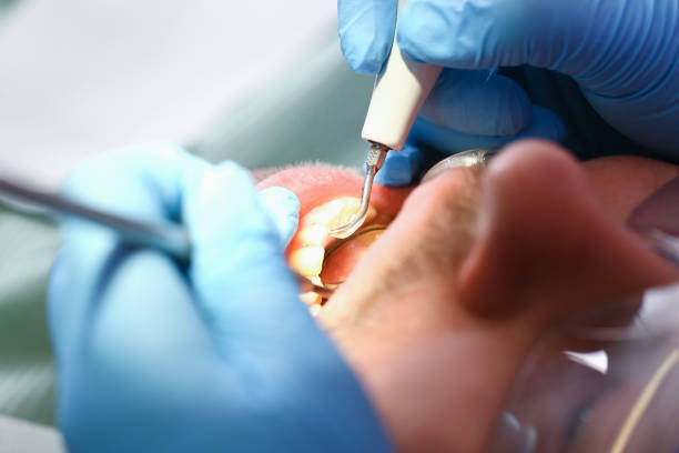 Best Emergency Tooth Extraction in Campbellsville, KY